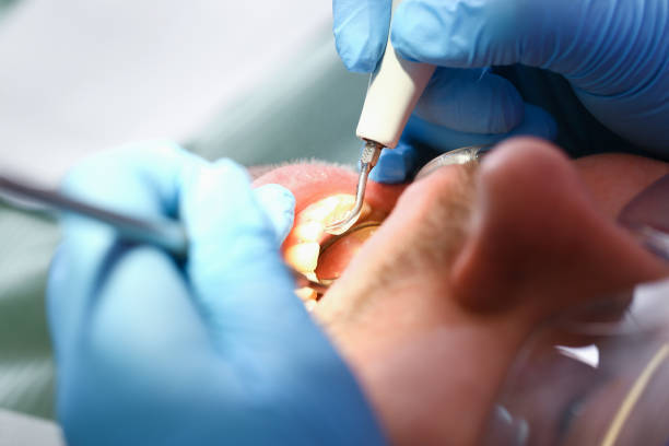 Best Chipped Tooth Repair Near Me  in Moreauville, LA